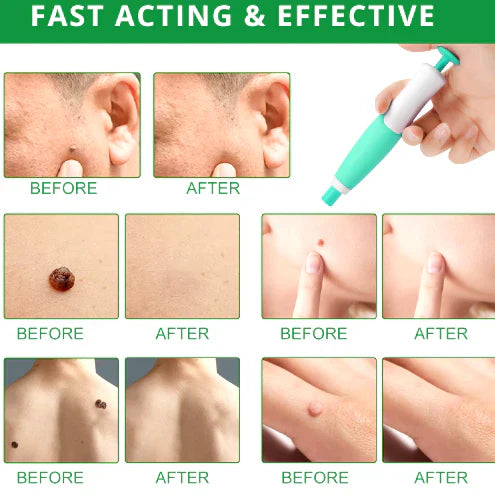 2-In-1 Painless Skin Tag, Mole, And Wart Removal Kit