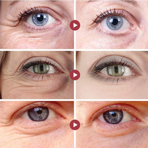 Anti Wrinkle Eye Bag Remover Cream Anti Wrinkle Eye Bag Remover Cream