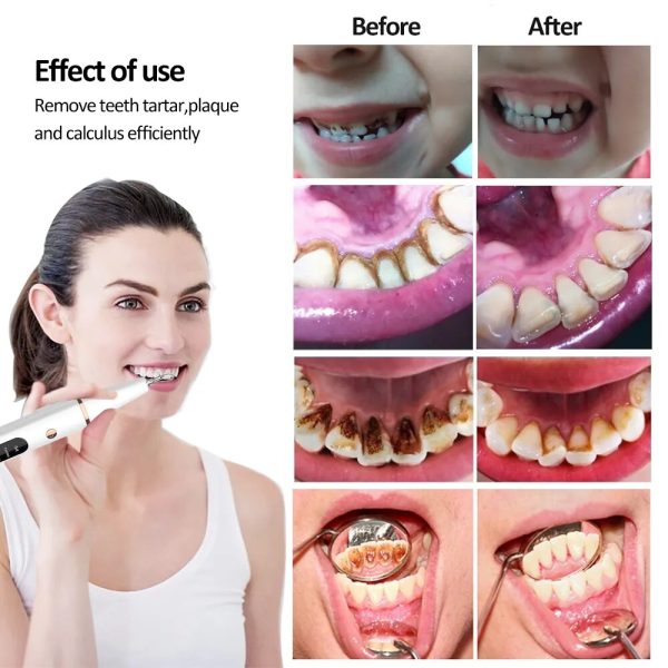 Electric Dental Calculus Remover Electric Dental Calculus Remover