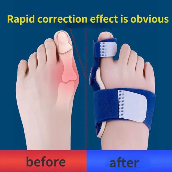 Flexfix Toe Splint
