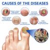 Fungus Laser Therapy Device Fungus Laser Therapy Device