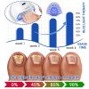 Fungus Laser Therapy Device Fungus Laser Therapy Device