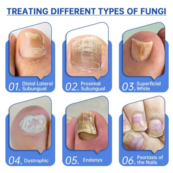 Fungus Laser Therapy Device Fungus Laser Therapy Device