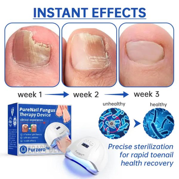 Fungus Laser Therapy Device Fungus Laser Therapy Device