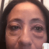 Instant Eye Bag Removal Instant Eye Bag Removal