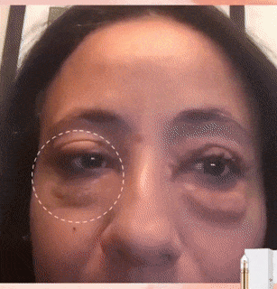 Instant Eye Bag Removal Instant Eye Bag Removal