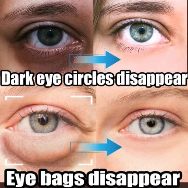Instant Eye Bag Removal Instant Eye Bag Removal