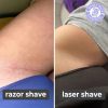 Laser Hair Remover Laser Hair Remover
