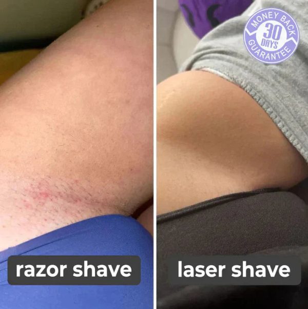 Laser Hair Remover Laser Hair Remover