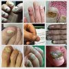 Nail Fungus Defender Serum Nail Fungus Defender Serum