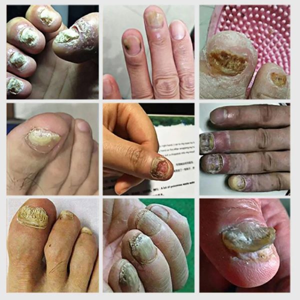 Nail Fungus Defender Serum Nail Fungus Defender Serum