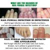 Nail Fungus Defender Serum Nail Fungus Defender Serum