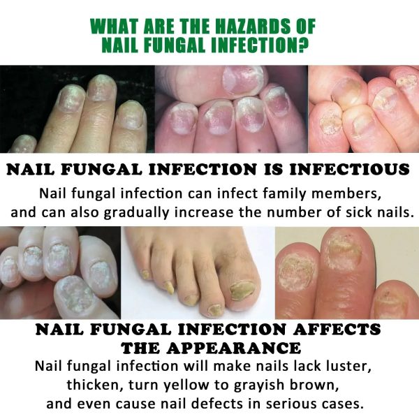 Nail Fungus Defender Serum Nail Fungus Defender Serum