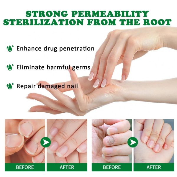 Nail Fungus Defender Serum Nail Fungus Defender Serum