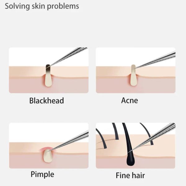 Perofessional Facial Blackheads Remover Perofessional Facial Blackheads Remover