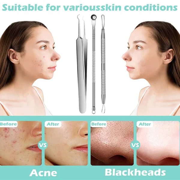 Perofessional Facial Blackheads Remover Perofessional Facial Blackheads Remover