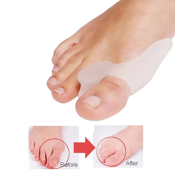Silicone Toes Valgus Corrector Silicone Toes Valgus Corrector