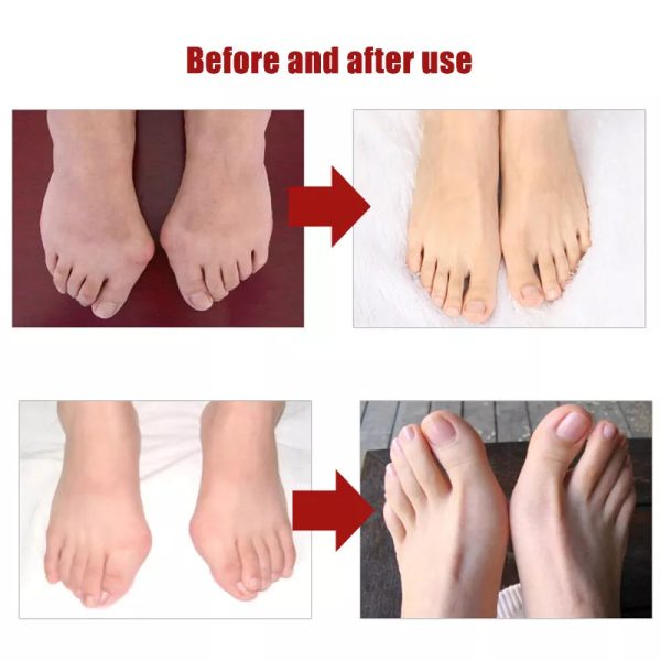 Silicone Toes Valgus Corrector Silicone Toes Valgus Corrector