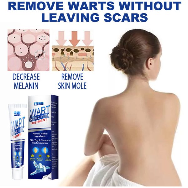 Wart Remover Cream Fast & Effective Wart Remover Cream Fast & Effective